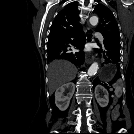 Aortic intramural hematoma from penetrating atherosclerotic ulcer (Radiopaedia 31137-31836 C 43).jpg