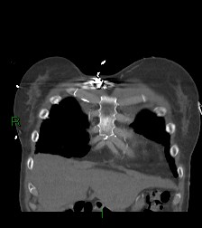 Aortic valve endocarditis (Radiopaedia 87209-103485 D 61).jpg