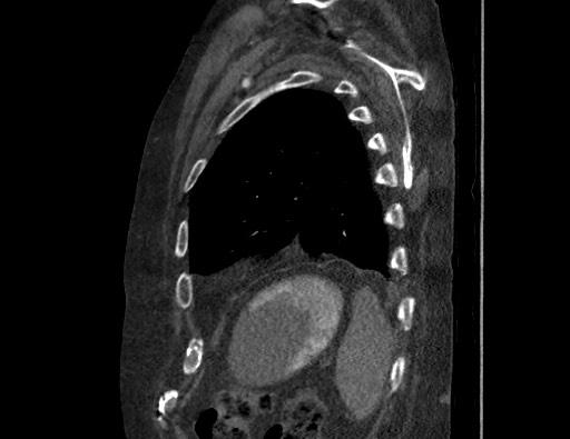 Aortoesophageal fistula with endovascular repair (Radiopaedia 73781-84592 Sagittal C+ CTPA 168).jpg