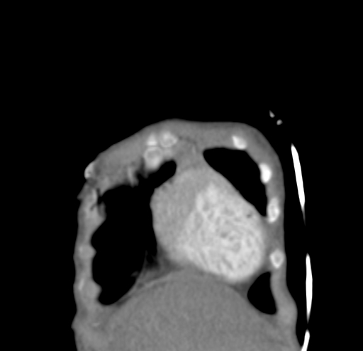 File:Aortopulmonary window, interrupted aortic arch and large PDA giving the descending aorta (Radiopaedia 35573-37074 D 1).jpg