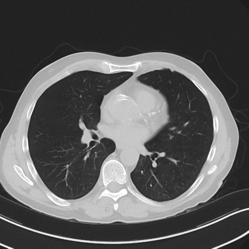 Apical pulmonary metastasis (Radiopaedia 46338-50754 Axial non-contrast 36).png