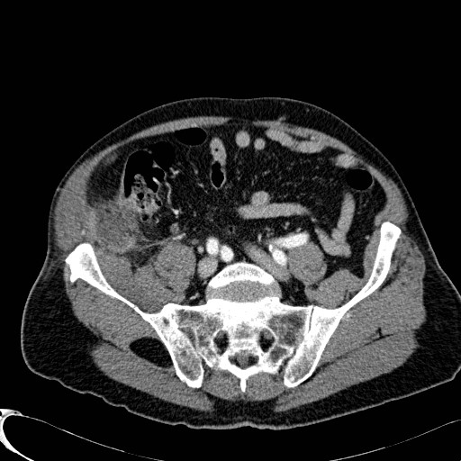 Appendiceal adenocarcinoma complicated by retroperitoneal abscess (Radiopaedia 58007-65039 B 102).jpg