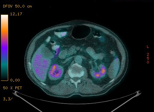Appendiceal adenocarcinoma complicated by retroperitoneal abscess (Radiopaedia 58007-65041 Axial PET-CT 117).jpg