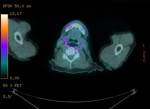 Appendiceal adenocarcinoma complicated by retroperitoneal abscess (Radiopaedia 58007-65041 Axial PET-CT 16).jpg