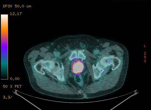 Appendiceal adenocarcinoma complicated by retroperitoneal abscess (Radiopaedia 58007-65041 Axial PET-CT 190).jpg
