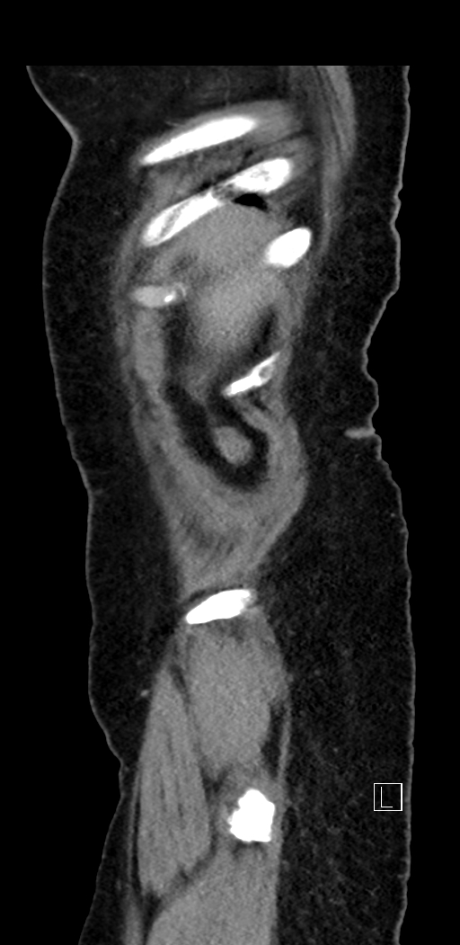 Appendiceal hemorrhage (Radiopaedia 70830-81025 Sagittal C+ delayed 11).jpg