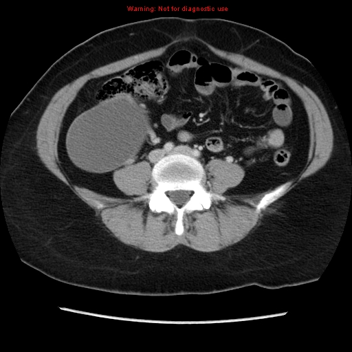 Appendiceal mucinous cystadenoma (Radiopaedia 8263-9111 Axial liver window 52).jpg