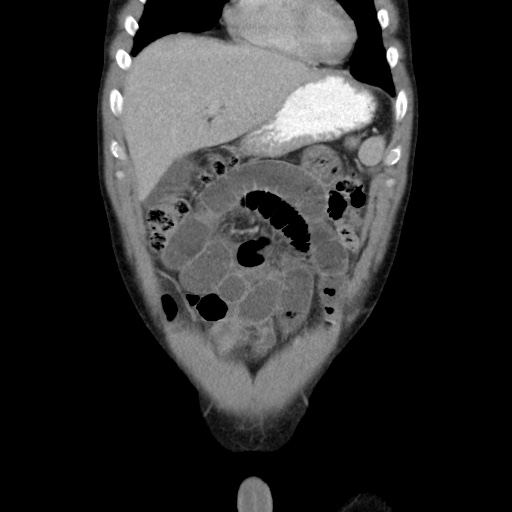 Appendicitis complicated by post-operative collection (Radiopaedia 35595-37114 B 15).jpg