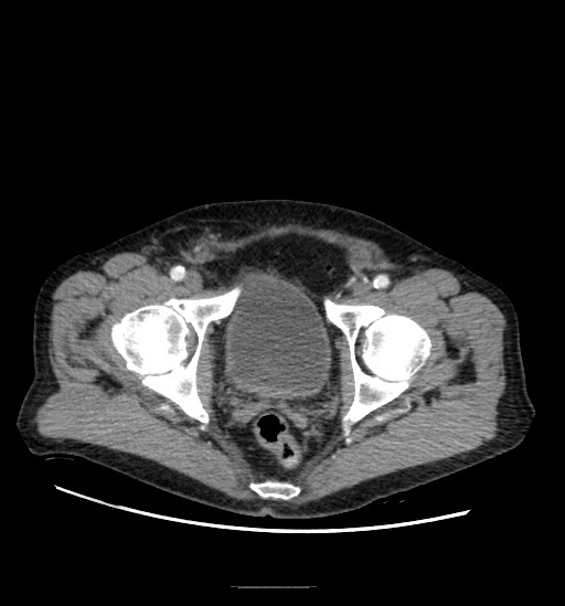 Appendicitis with localized perforation and abscess formation (Radiopaedia 49035-54130 A 81).jpg