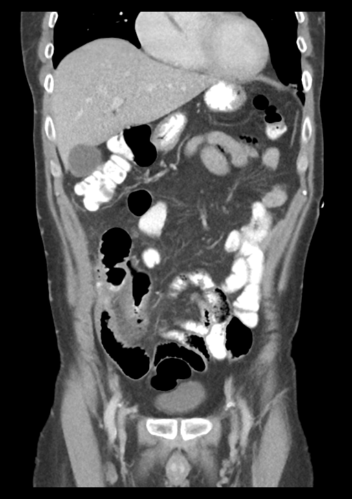 Appendicitis with thickening of the terminal ileum (Radiopaedia 42432-45550 B 18).png
