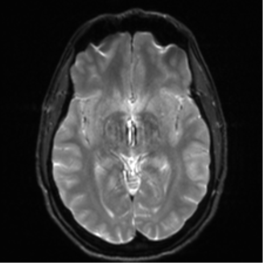 Arachnoid cyst - cerebellopontine angle (Radiopaedia 59689-67083 Axial DWI 17).png
