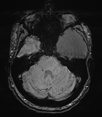 Arachnoid cyst with subdural hematoma (Radiopaedia 85892-101743 Axial SWI 21).png