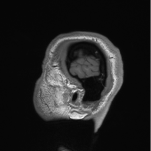 Arachnoid cyst with subdural hematoma (Radiopaedia 85892-101743 Sagittal T1 85).png