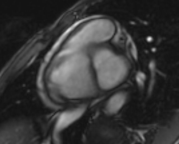 Arrhythmogenic right ventricular cardiomyopathy (Radiopaedia 69564-79464 short axis cine 228).jpg
