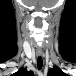 File:Arteriovenous malformation of the neck (Radiopaedia 53935-60062 D 6).jpg