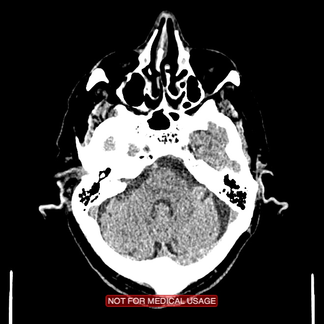 Artery of Percheron infarction (Radiopaedia 28679-28967 Axial non-contrast 29).jpg
