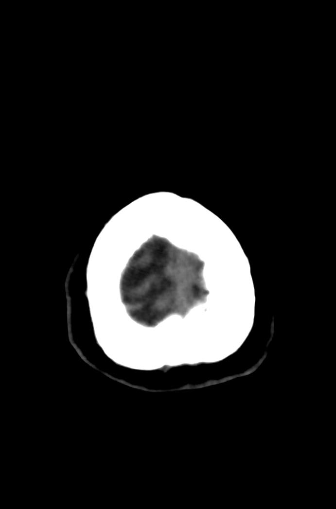 Artery of Percheron infarction (Radiopaedia 80613-94202 Axial non-contrast 184).jpg