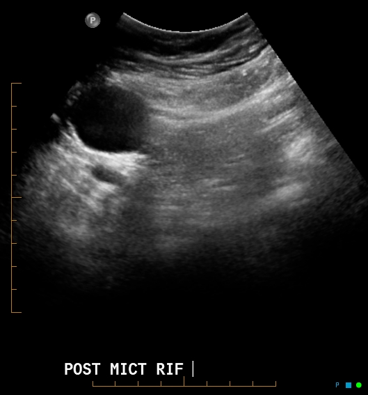 File:Artificial urethral sphincter (Radiopaedia 46937-51465 Transverse 1).jpg