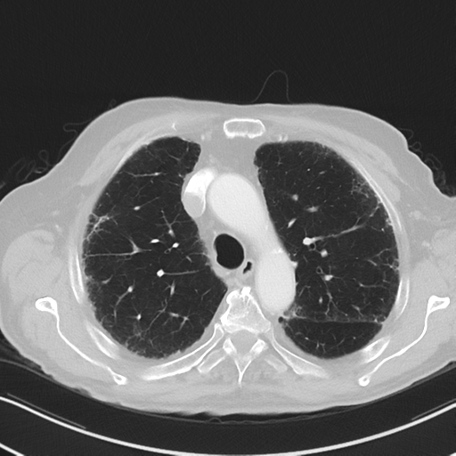 File:Asbestosis (Radiopaedia 56192-62864 Axial lung window 21).png
