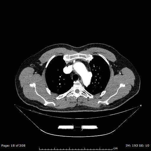 File:Ascending aortic aneurysm (Radiopaedia 50086-55404 A 3).jpg