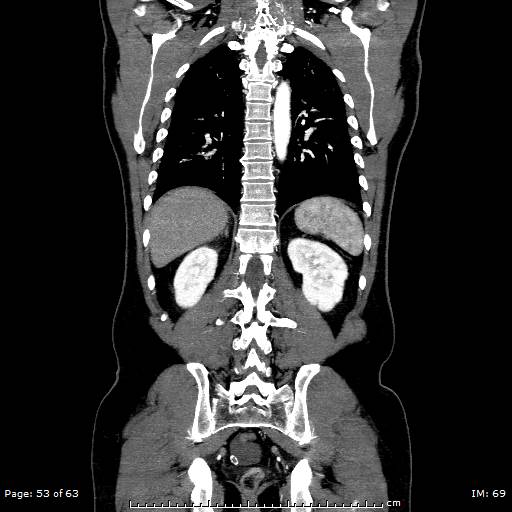 Ascending aortic aneurysm (Radiopaedia 50086-55404 B 53).jpg