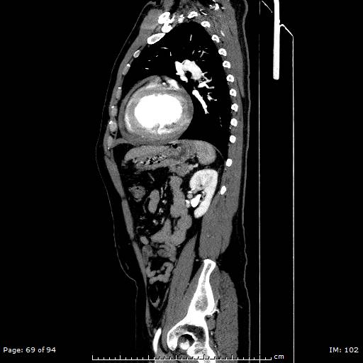 File:Ascending aortic aneurysm (Radiopaedia 50086-55404 C 49).jpg