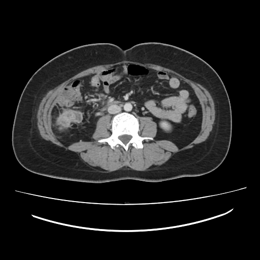 File:Ascending retrocecal appendicitis with liver abscesses (Radiopaedia 60066-67615 B 51).jpg