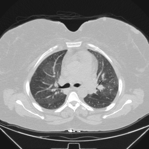 Aspergilloma (Radiopaedia 39611-41932 Axial lung window 49).jpg