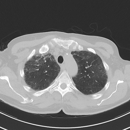File:Aspergilloma on background pulmonary fibrosis (Radiopaedia 60942-68757 A 14).jpg