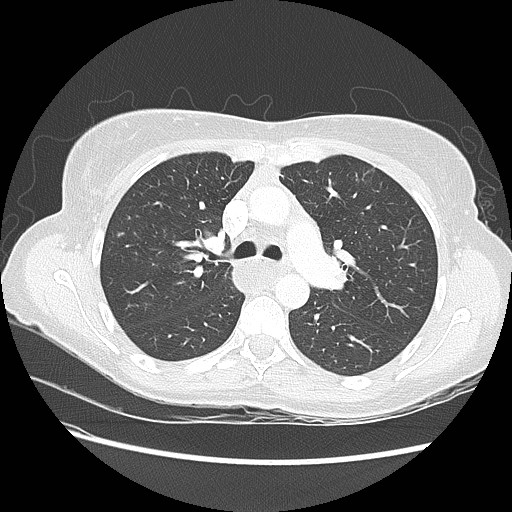 Aspiration pneumonia secondary to laparoscopic banding (Radiopaedia 18345-18183 lung window 39).jpg