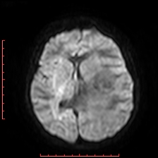 Astroblastoma (Radiopaedia 74287-85162 Axial DWI 57).jpg
