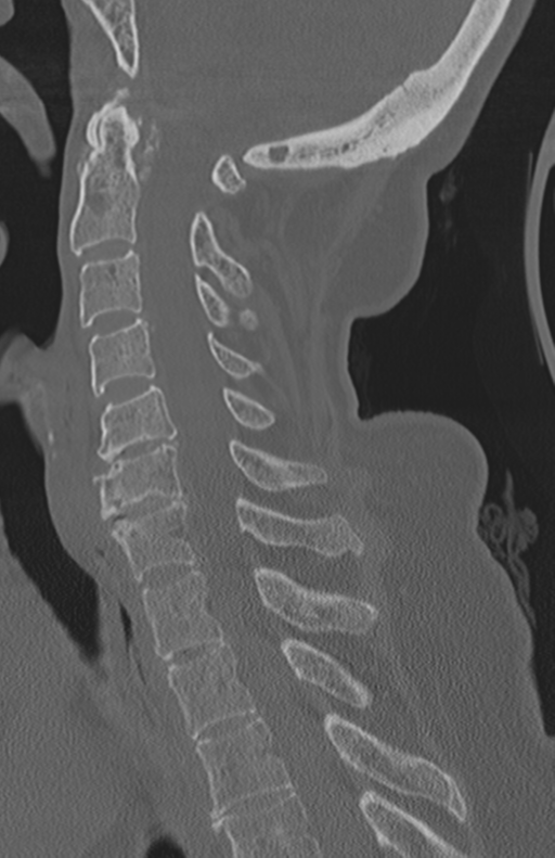 Atlanto-axial subluxation (Radiopaedia 36610-38176 Sagittal bone window 42).png