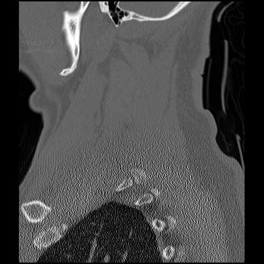 Atlanto-occipital dissociation injury (Radiopaedia 29274-29698 Sagittal bone window 50).png