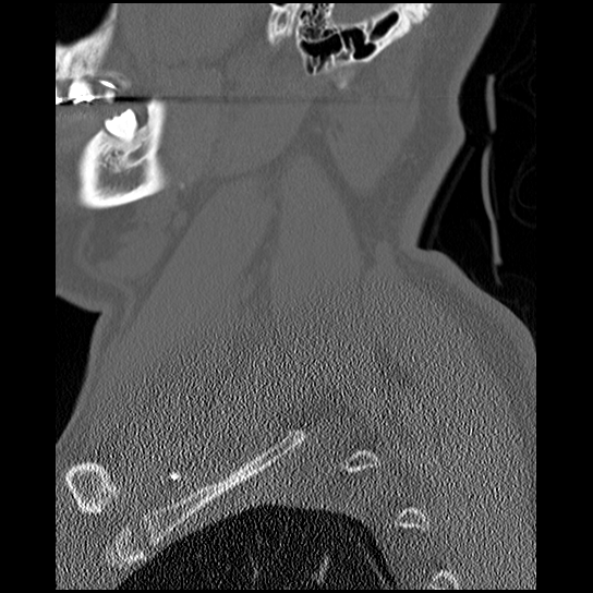 Atlanto-occipital dissociation injury (Radiopaedia 29274-29698 Sagittal bone window 6).png