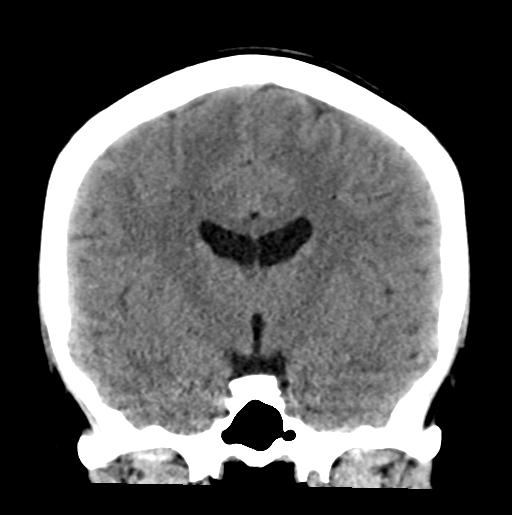 File:Atretic encephalocoele with inferior vermis hypoplasia (Radiopaedia 30443-31107 Coronal non-contrast 19).jpg