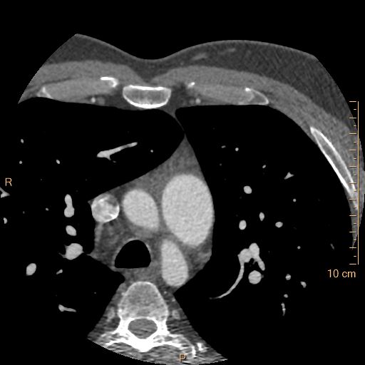 Atrial septal defect (upper sinus venosus type) with partial anomalous pulmonary venous return into superior vena cava (Radiopaedia 73228-83961 A 20).jpg