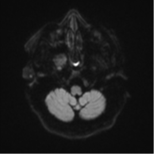 File:Atypical meningioma (WHO Grade II) (Radiopaedia 54742-60981 Axial DWI 33).png