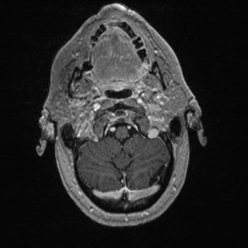 Atypical meningioma (grade II) - en plaque (Radiopaedia 29633-30147 Axial T1 C+ 28).jpg