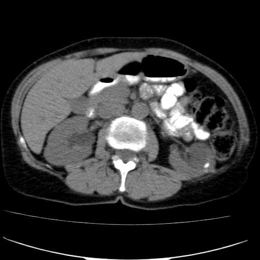 File:Atypical renal cyst (Radiopaedia 17536-17251 non-contrast 16).jpg