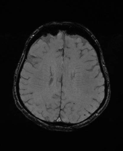 Autoimmune limbic encephalitis (Radiopaedia 30363-31005 SWI - magnitude 52).jpg