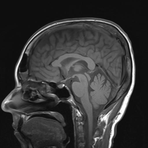 File:Autoimmune limbic encephalitis (Radiopaedia 30363-31005 Sagittal T1 13).jpg
