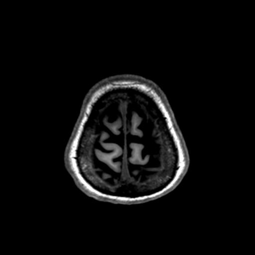 File:Autoimmune limbic encephalitis (Radiopaedia 30363-31005 T1 Axial 1mm 139).jpg