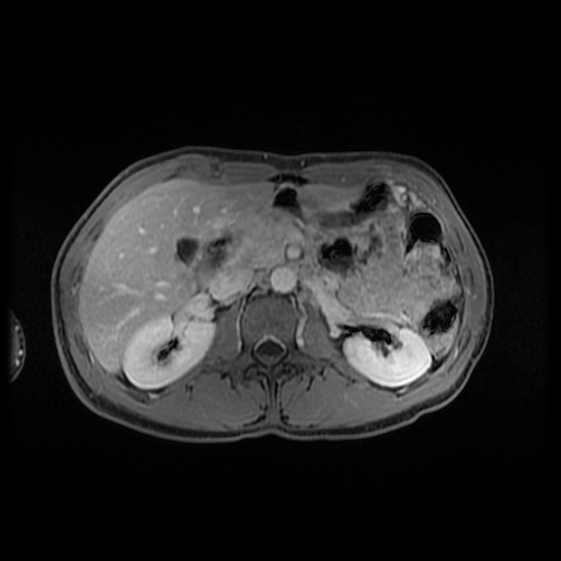Autoimmune pancreatitis (Radiopaedia 69751-79729 Axial T1 C+ fat sat 67).jpg