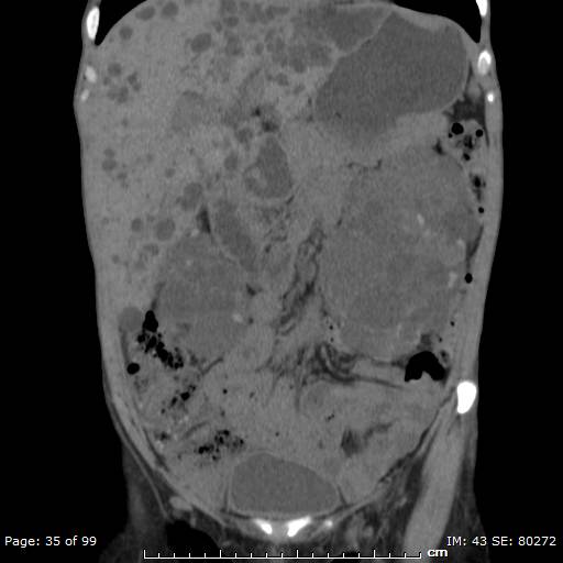 File:Autosomal dominant polycystic kidney disease (Radiopaedia 44122-47684 Coronal 13).jpg