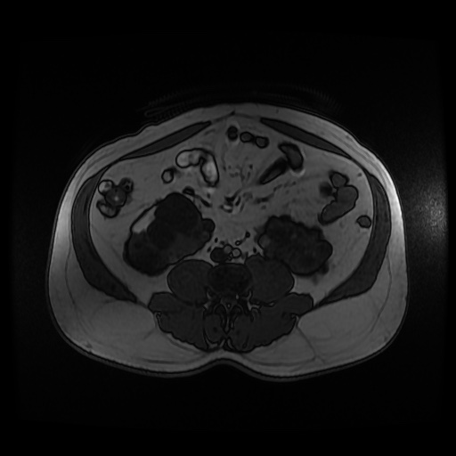 Autosomal dominant polycystic kidney disease (Radiopaedia 50259-55611 Axial 2D Dual Echo 63).jpg
