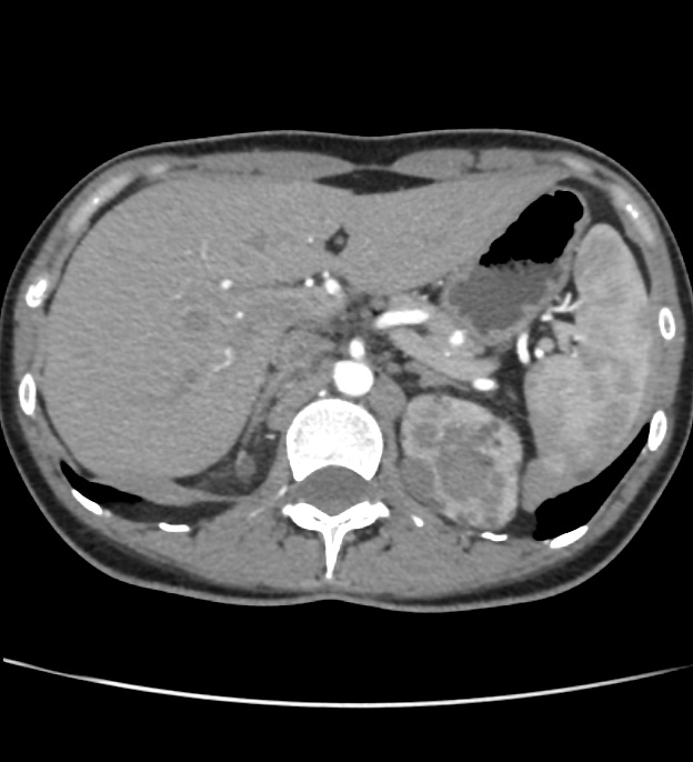Autosomal dominant polycystic kidney disease - early onset (Radiopaedia 40734-43387 B 5).jpg
