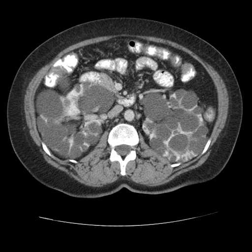 Autosomal dominant polycystic kidney disease with hepatic involvement (Radiopaedia 32693-33662 B 34).jpg