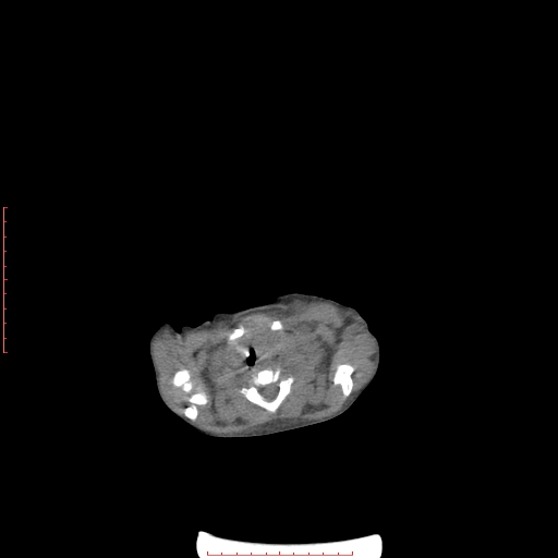Autosomal recessive polycystic kidney disease associated with Caroli disease (Radiopaedia 61932-69984 Axial non-contrast 8).jpg