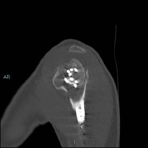 Avascular necrosis after fracture dislocations of the proximal humerus (Radiopaedia 88078-104653 Sagittal bone window 19).jpg