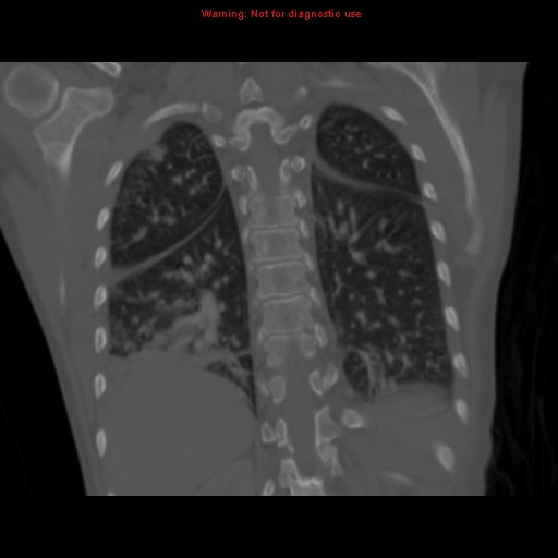 Avascular necrosis in sickle cell disease (Radiopaedia 17448-17152 Coronal bone window 96).jpg